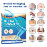 2 in 1 Auto Skin Tag Removal Kit Painless Mole Wart Remover Equipment Micro Skin Tag Treatment Tool Easy to Clean Skin Care Tool