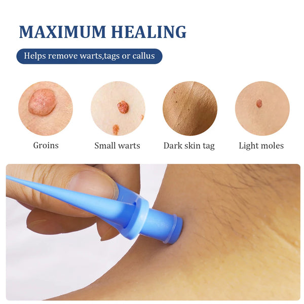 2 in 1 Auto Skin Tag Removal Kit Painless Mole Wart Remover Equipment Micro Skin Tag Treatment Tool Easy to Clean Skin Care Tool