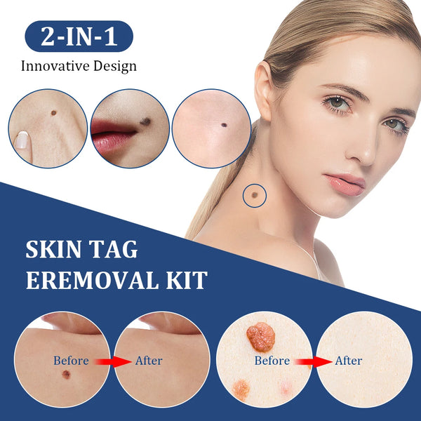 2 in 1 Auto Skin Tag Removal Kit Painless Mole Wart Remover Equipment Micro Skin Tag Treatment Tool Easy to Clean Skin Care Tool